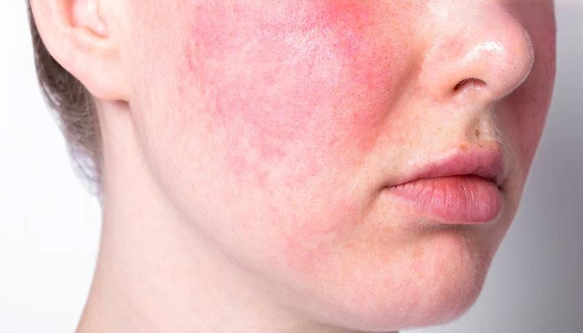 ئەم نیشانەیە لەسەر پێست مانای ئەوەیە کە سییەکانت باش نین!