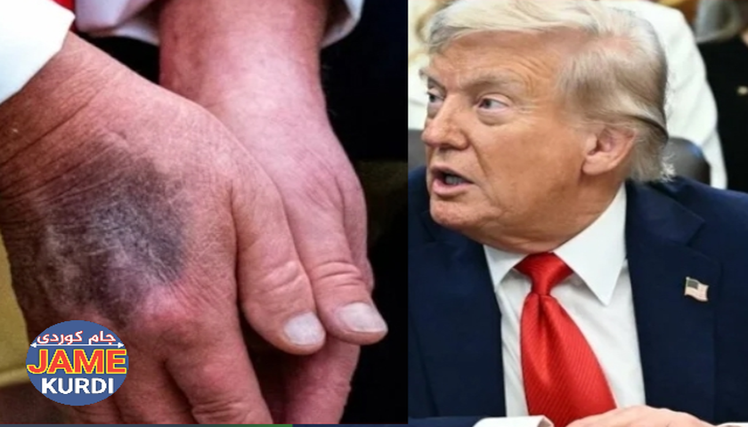 ترەمپ ڕۆژانە 325 میلیگرام ئەسپرین دەخوات، ئەوەش تەندروستی خستوەتە ژێر مەترسییەوە